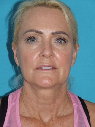 Before Mini Facelift